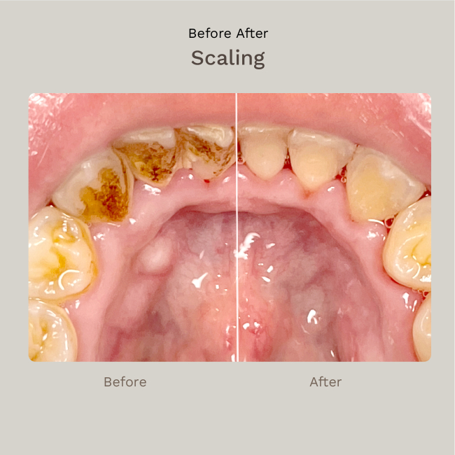 Dental Spa and Scaling