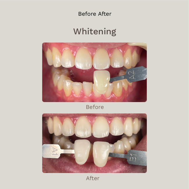 Dental Whitening