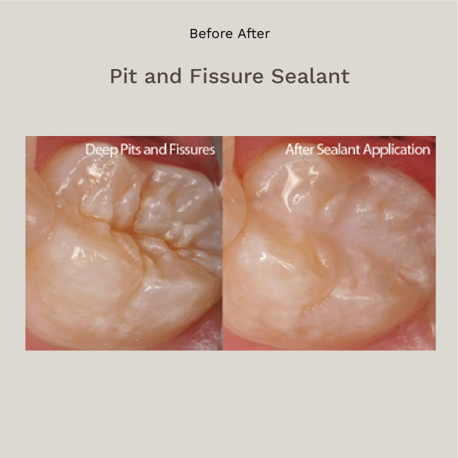 Pit and Fissure Sealant