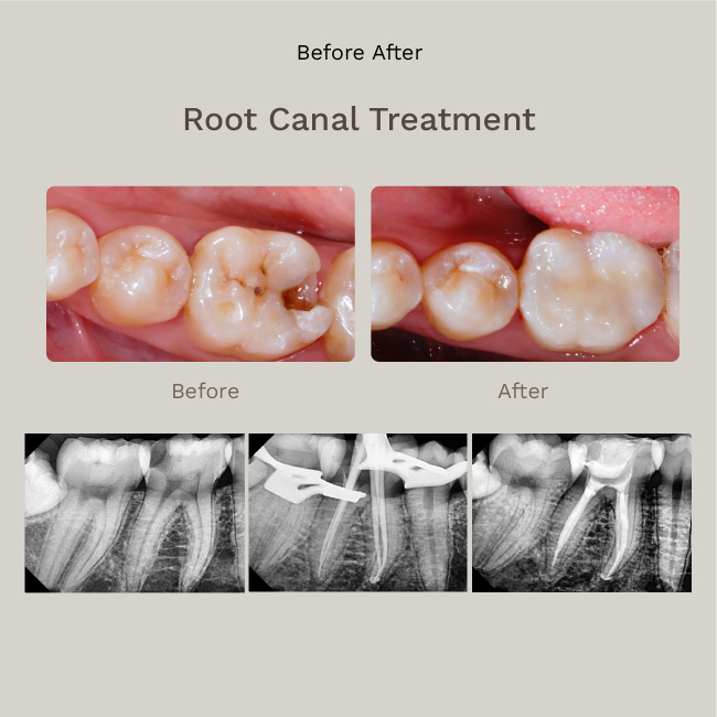 Root Canal Treatment