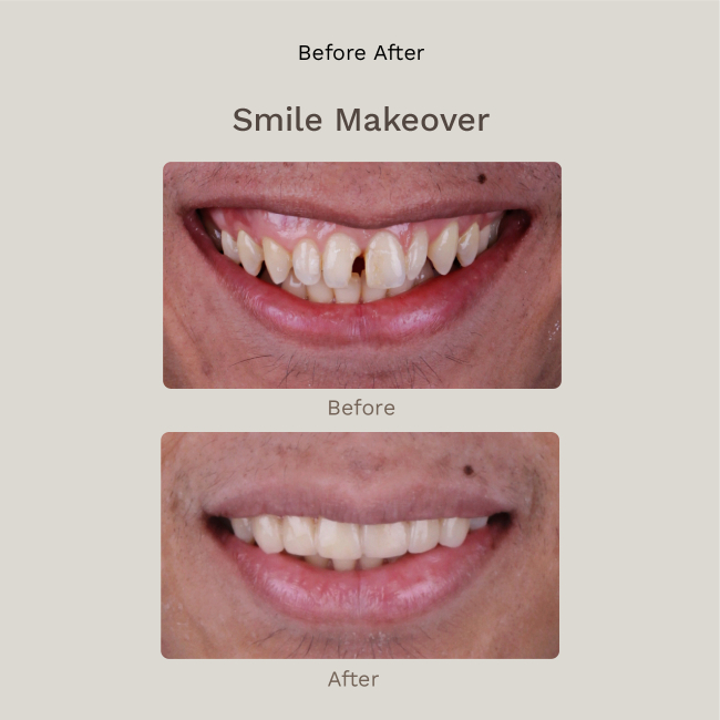 Smile Makeover